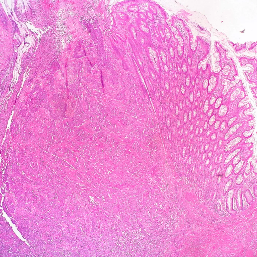 Lâmina de tecido de carcinoma medular do cólon corada em rosa e roxo, vista ao microscópio