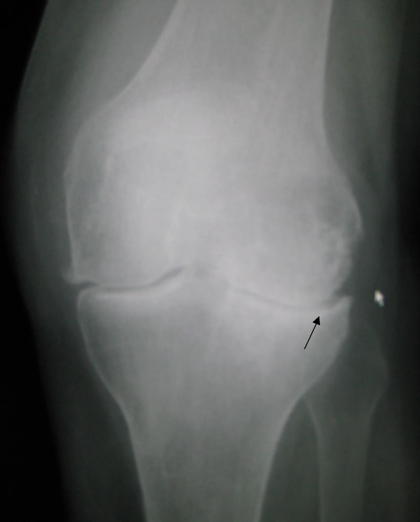 Radiografia de joelho com artrose e redução do espaço articular